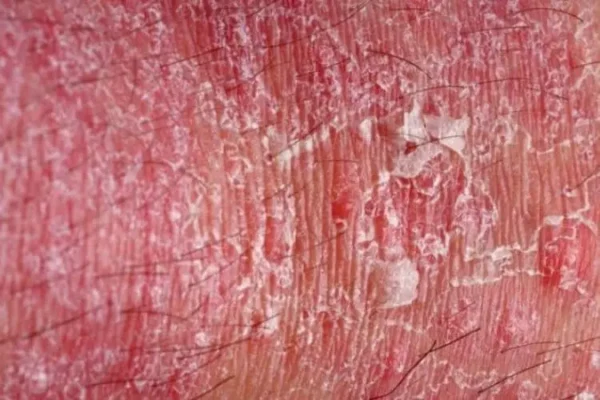 Da dương vật bị khô