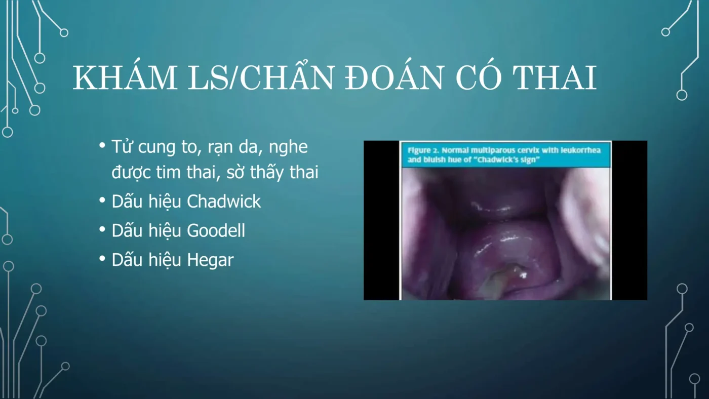 Dấu hiệu Chadwick (Chadwick's Sign)