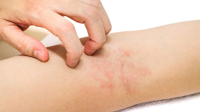 Máy triệt lông mini có hiệu quả không? Phân tích Nguyên lý, Phân loại và Tiêu chí lựa chọn 5 Đỏ rát, châm chích