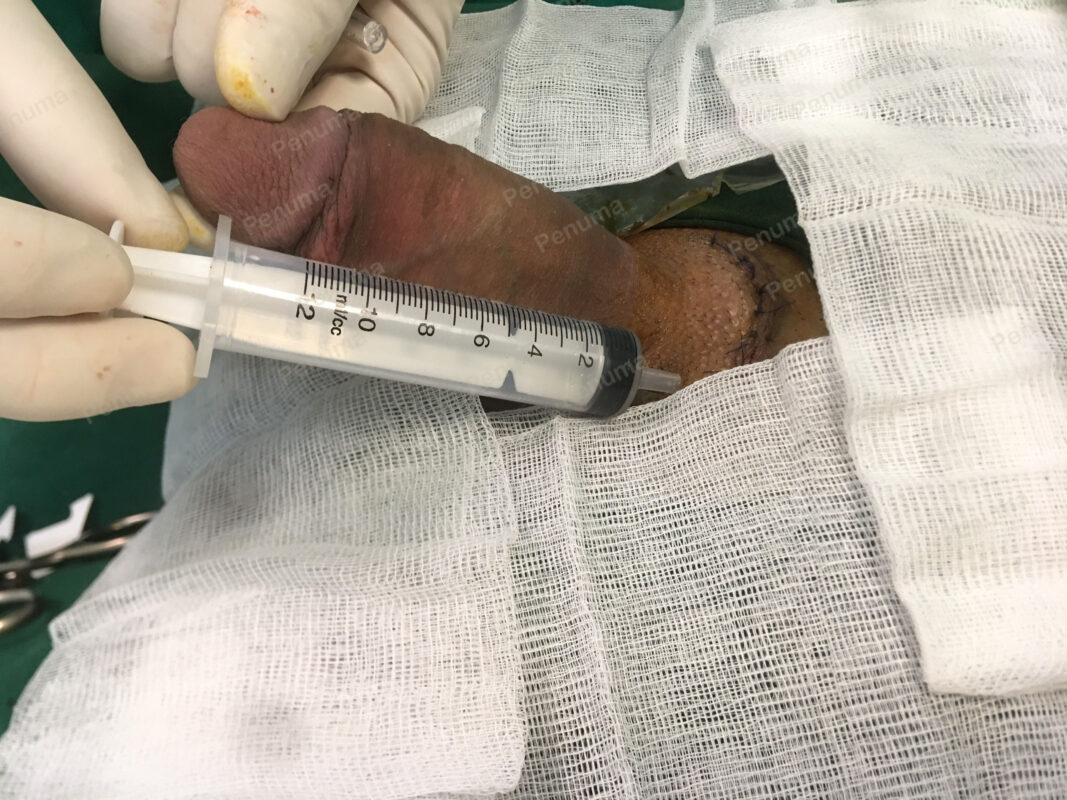 độn dương vật