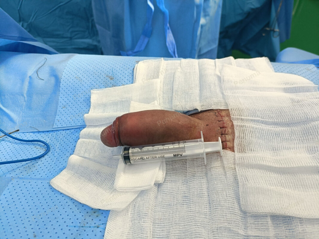 Độn dương vật