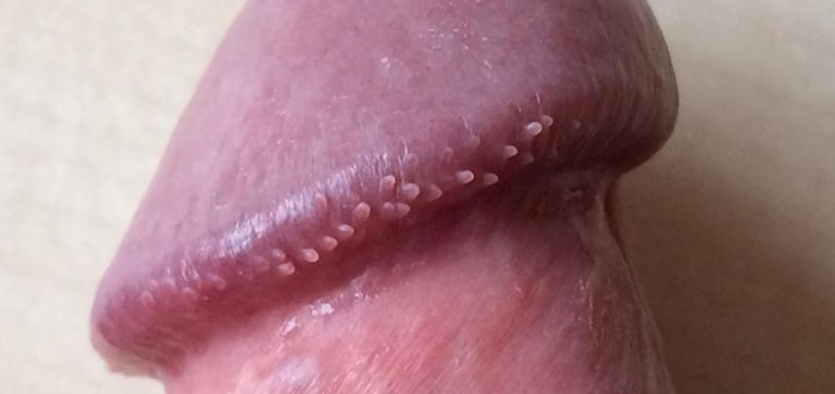 Gai Dương Vật: Nguyên Nhân, Triệu Chứng, Phân Loại và Các Phương Pháp Điều Trị 1 Gai dương vật