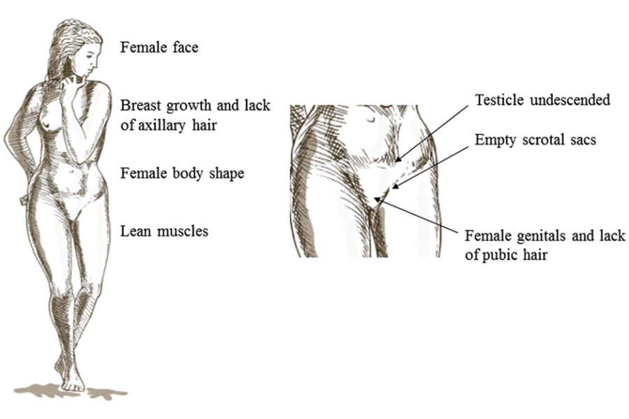 Hội chứng không nhạy cảm với Androgen (AIS)