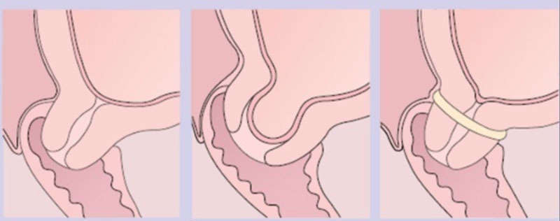 Cổ tử cung ngắn: Thông tin, Nguyên nhân, Ảnh hưởng và Cách điều trị 12 khâu vòng