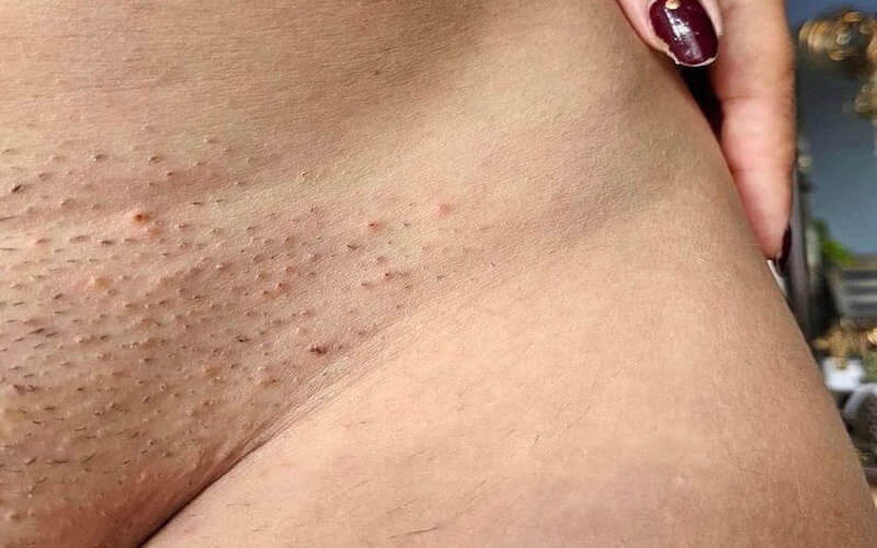 Kem Tẩy Lông Vùng Kín Cho Bà Bầu: Thông Tin An Toàn, Phân Loại, Lưu Ý và Hướng Dẫn Sử Dụng 2 kích ứng da