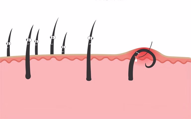 Cạo Lông Vùng Kín Bị Nổi Mụn: Thông tin, Nguyên nhân, Cách điều trị và Phòng ngừa 10 lông mọc ngược