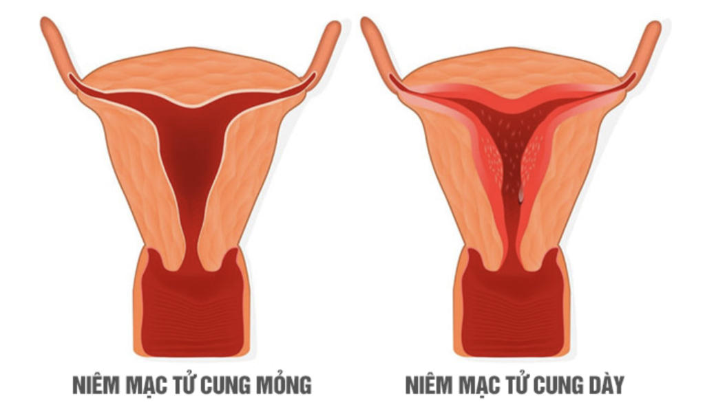 niêm mạc tử cung mỏng và dày