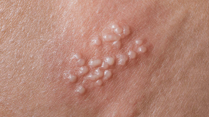 Nổi mụn nước ở vùng kín