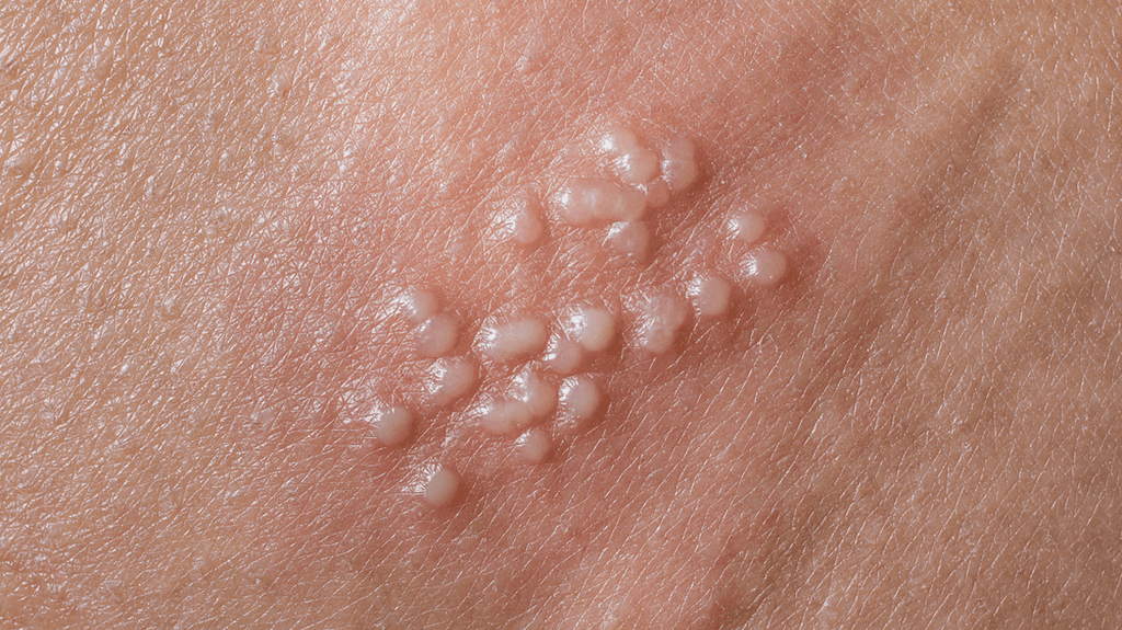 Nổi mụn nước ở vùng kín