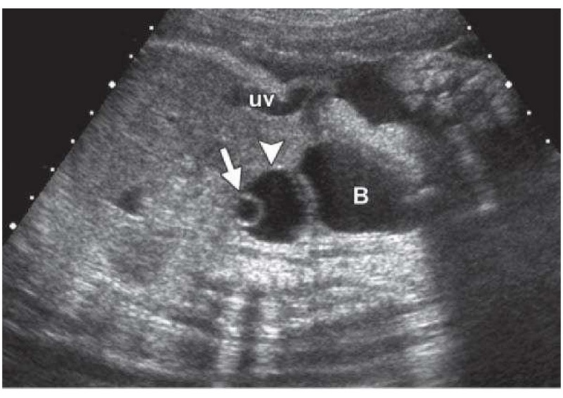 Nang trứng: Thông tin, Cấu trúc, Chức năng và Quá trình phát triển 13 Siêu âm nang trứng