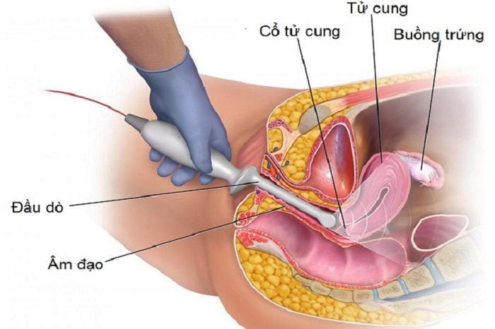 Cổ tử cung ngắn: Thông tin, Nguyên nhân, Ảnh hưởng và Cách điều trị 4 Siêu âm qua ngả âm đạo