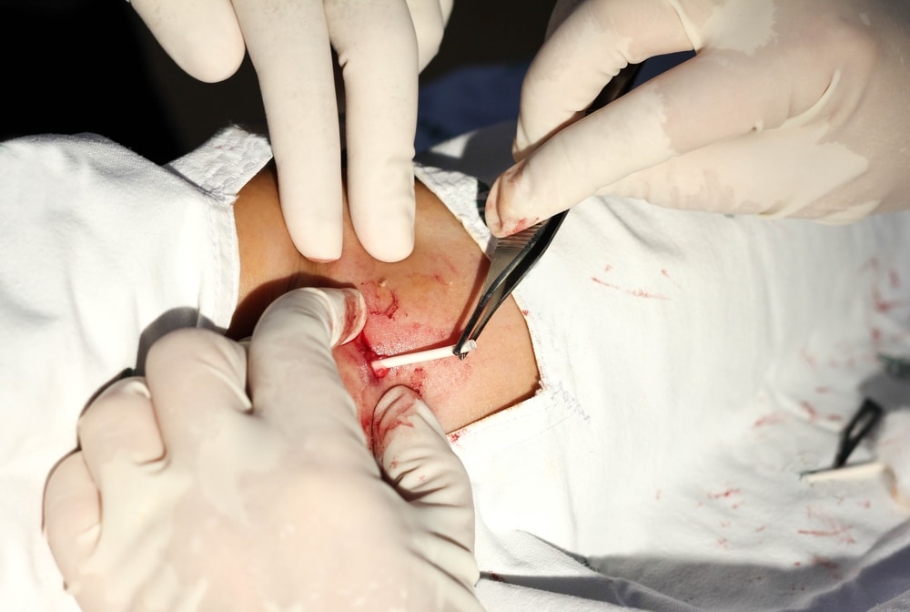 Tháo que tránh thai