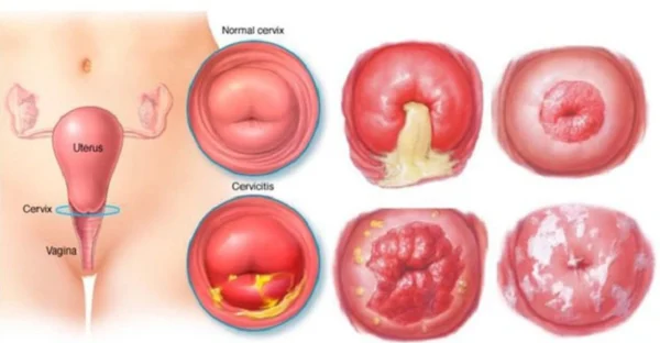 Viêm cổ tử cung dấu hiệu