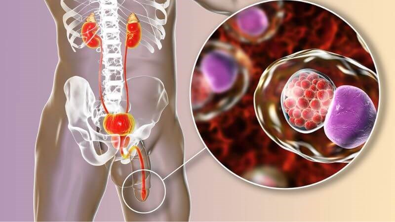 Cách Khử Mùi Hôi Cậu Nhỏ Tại Nhà: Nguyên Nhân, Phương Pháp An Toàn và Phòng Ngừa Hiệu Quả 3 Viêm niệu đạo