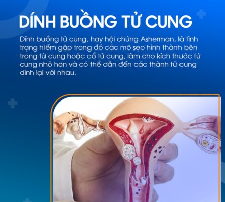 Đặt vòng chống dính buồng tử cung