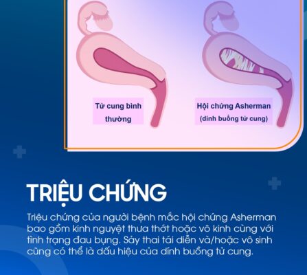 Đặt vòng chống dính buồng tử cung
